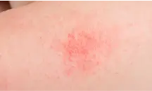 Mild skin irritation